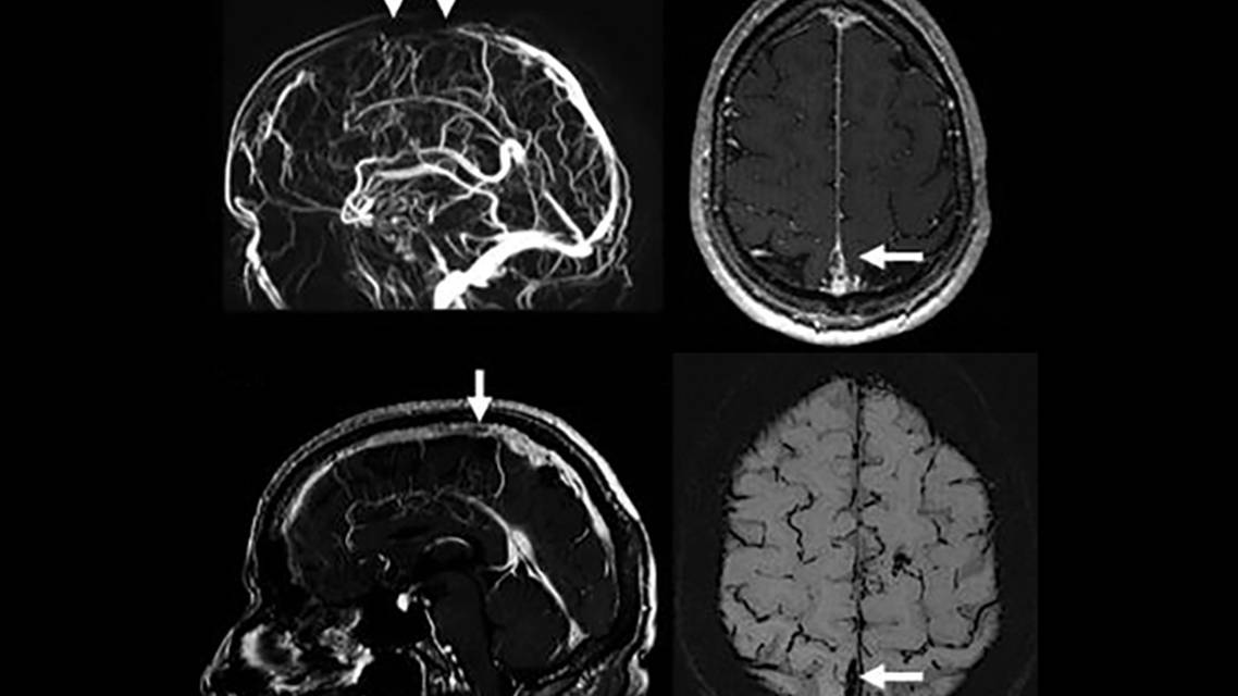 Headaches Not to Miss Regardless of the Patient Population Thunderclap Headache in the Emergency Department
