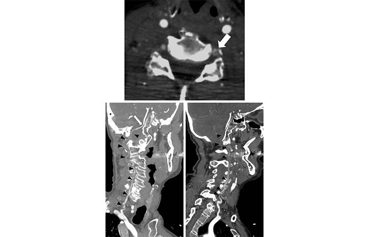 Bilateral Vertebral Artery Dissection and Occlusion After a Long Distance Open Water Swim
