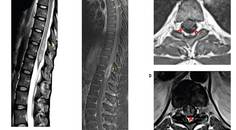 Neuromyelitis Optica Spectrum Disorder With Atypical Imaging Features