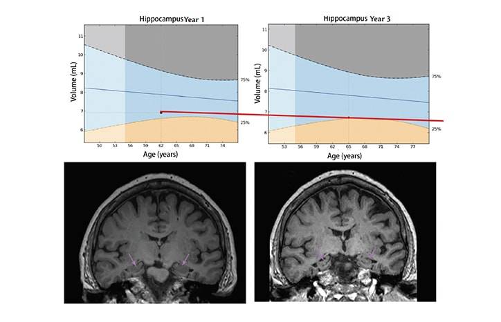 Quantitative Structural MRI for Neurocognitive Disorders