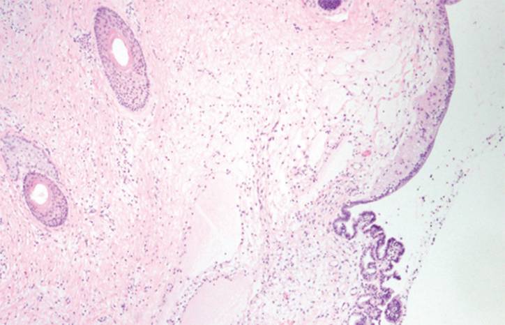 Case Report AntiNMDA Receptor Encephalitis