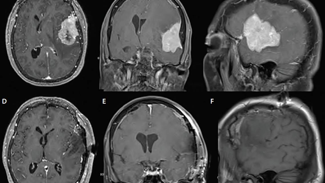 Challenge Case Report A Woman With a Large Dural Based Lesion