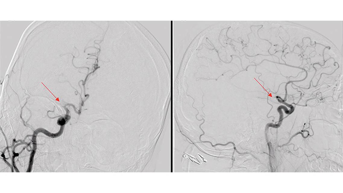 Stroke Snapshot Intracranial Vasculopathy in COVID 19