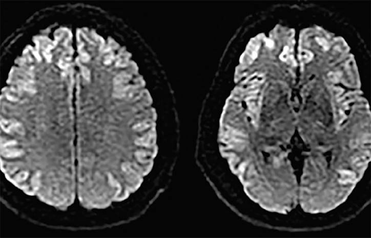 Hyperammonemic Crisis