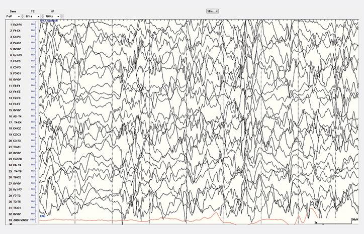 Epilepsy EssentialsInfantile Spasms The Biggest Little Seizures