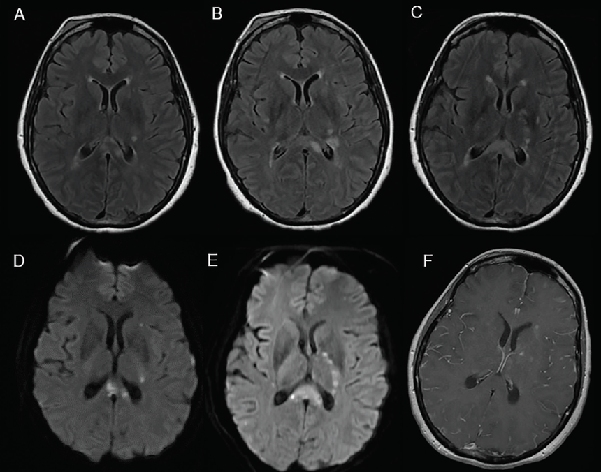 Corpus Callosum Infarct Symptoms