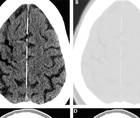 Stroke Snapshot Stroke Due to Hemodialysis Associated Air Embolism