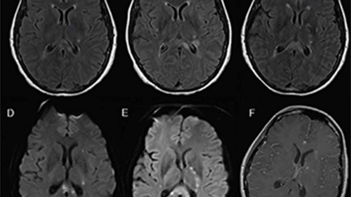 Case Challenge Recurrent Stroke Like Symptoms
