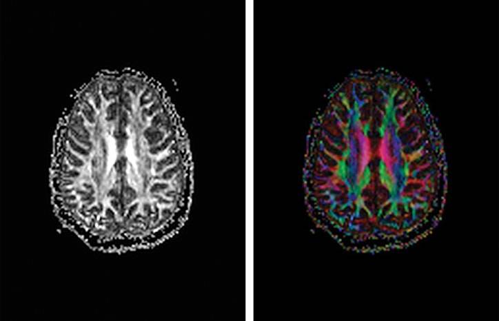 TBI Today Quantitative Diffusion Tensor Imaging for Assessment of Mild Traumatic Brain Injury