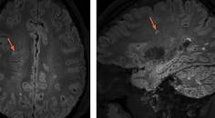 Multiple Sclerosis Minute The Central Vein Sign in Diagnosis of Multiple Sclerosis