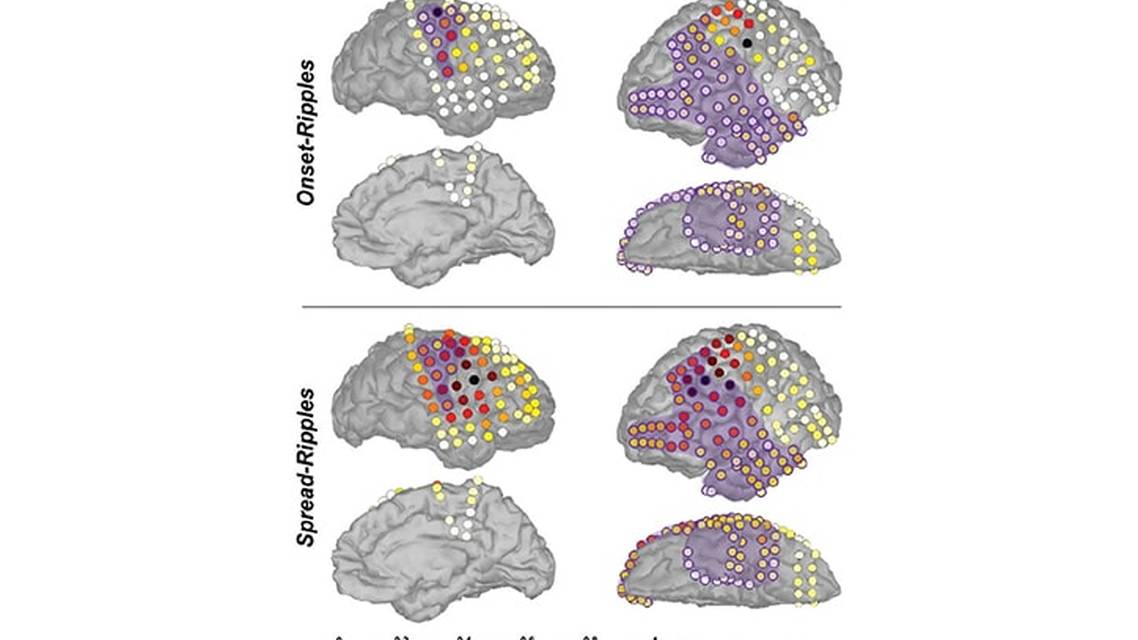 Epilepsy Essentials Novel Interictal Biomarkers for Delineating the Epileptogenic Zone in Children With Drug Resistant Epile
