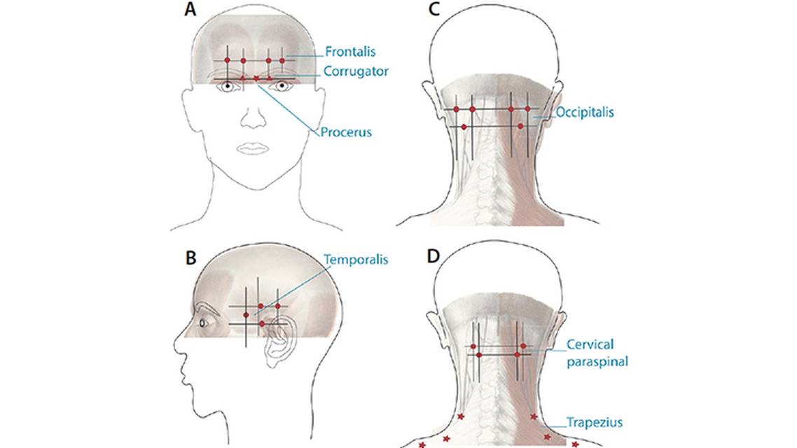 Procedural Treatments for Headache Disorders