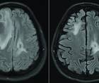 Figure 1 depicting the MRI of a brain