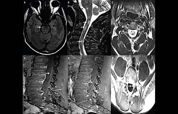 MOG Antibody Disease
