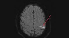 Stroke Snapshot Ulcerative Colitis and Stroke