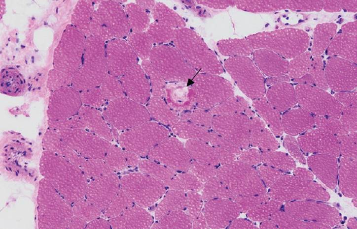 Challenge Case Report Progressive Muscle Weakness