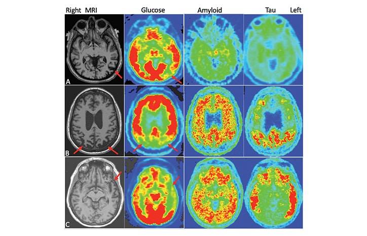 Dementia Innovations