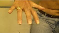Weakness and Atrophy of Right Hand Muscles in A 47yearold Man thumbnail