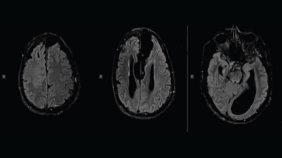 Return of Auras Following Treatment of Focal Onset Seizures with Responsive Neurostimulation