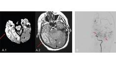 Neurologic Complications of Globally Prevalent Infectious Disorders A Focus on Syphilis Cysticercosis and Tuberculosis