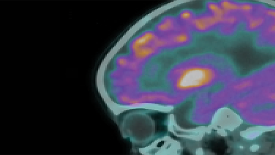 Madras Motor Neuron Disease