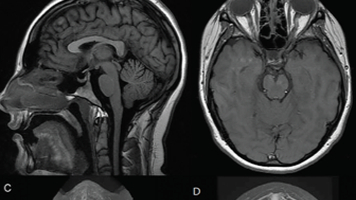 Idiopathic Intracranial Hypertension