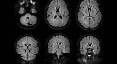 Acute Encephalopathy With Unusual Brain Lesions