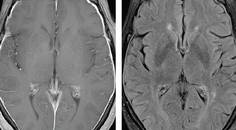 Meningeal Enhancement Seen on Workup for Memory Loss