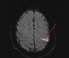 Stroke Snapshot Ulcerative Colitis and Stroke