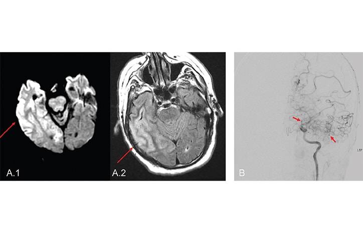 Neurologic Complications of Globally Prevalent Infectious Disorders A Focus on Syphilis Cysticercosis and Tuberculosis
