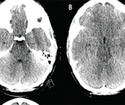 Case Report Noninvasive Intracranial Pressure Monitoring