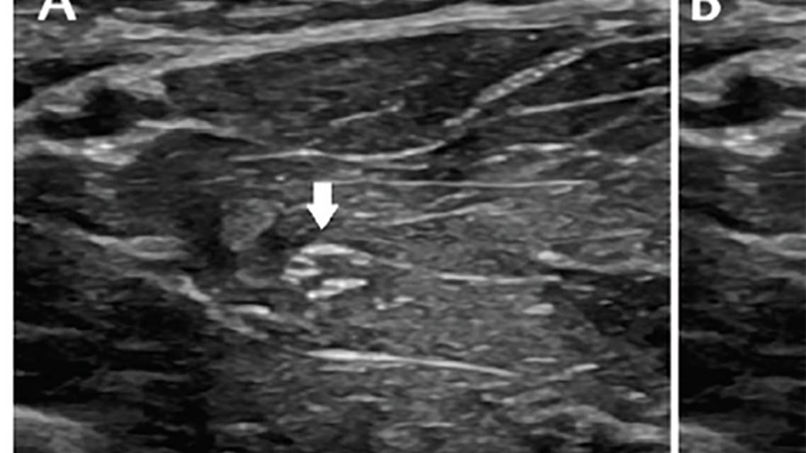 Neuromuscular Notes Neuromuscular Ultrasound in Polyneuropathy