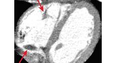Stroke Spotlight Hypercoagulable States in Ischemic Stroke