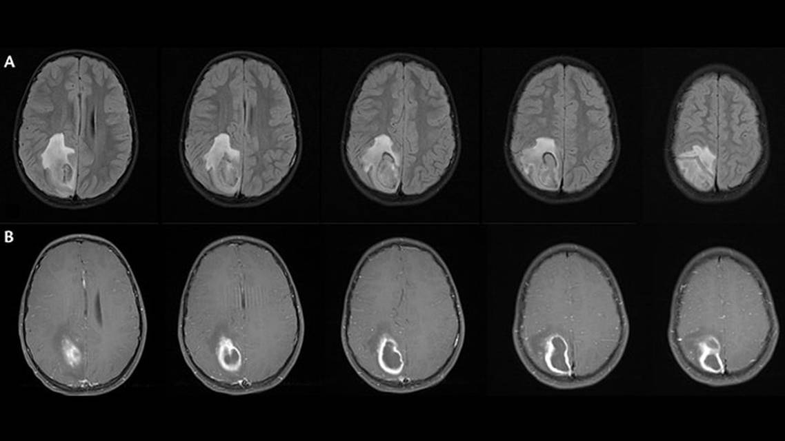 Focal Status Epilepticus 9 Years After Brain Abscess