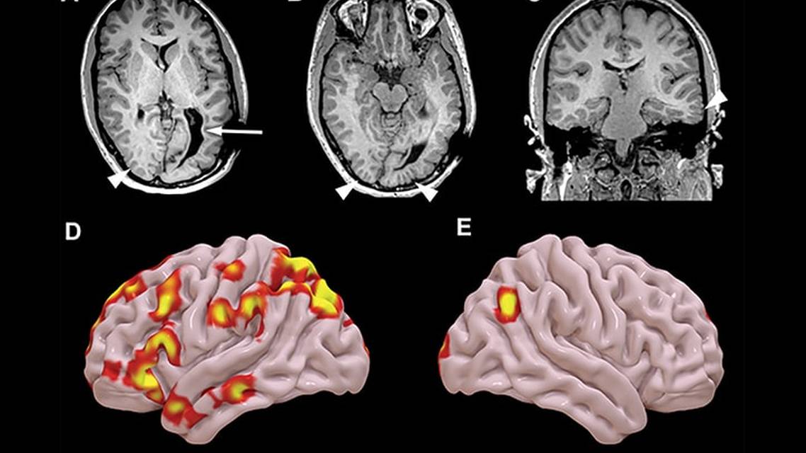 Neurostimulation in Drug Resistant Epilepsy