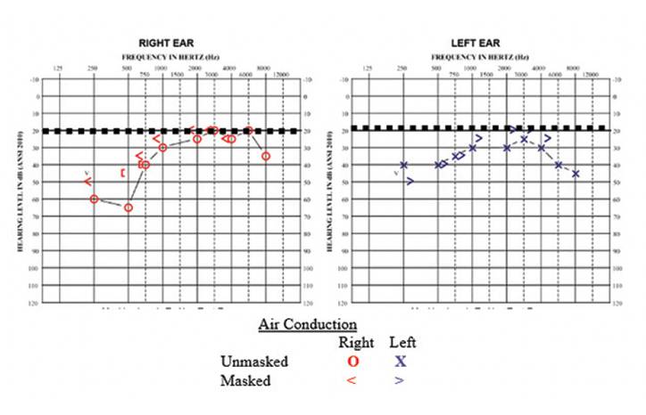 Acute Onset Weakness Deafness and Confusion A Case of Multisystem Thiamine Deficiency