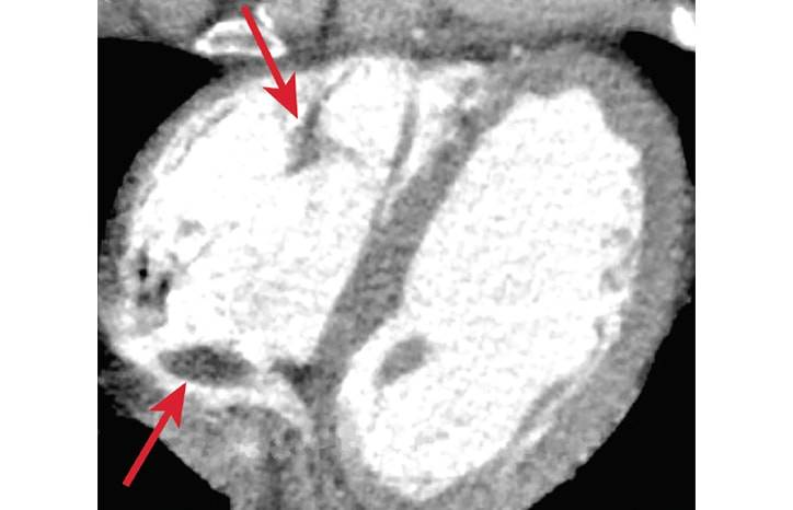 Stroke Spotlight Hypercoagulable States in Ischemic Stroke