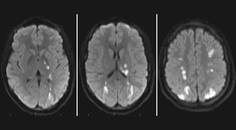 Stroke in a Young AdultImmunomodulation Responsive Bilateral Supraclinoid Carotid Artery Vasculopathy Secondary to Syste