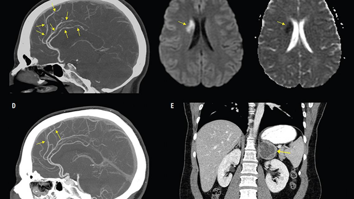 Cerebral Vasoconstriction and Vasospastic Angina Secondary to Pheochromocytoma