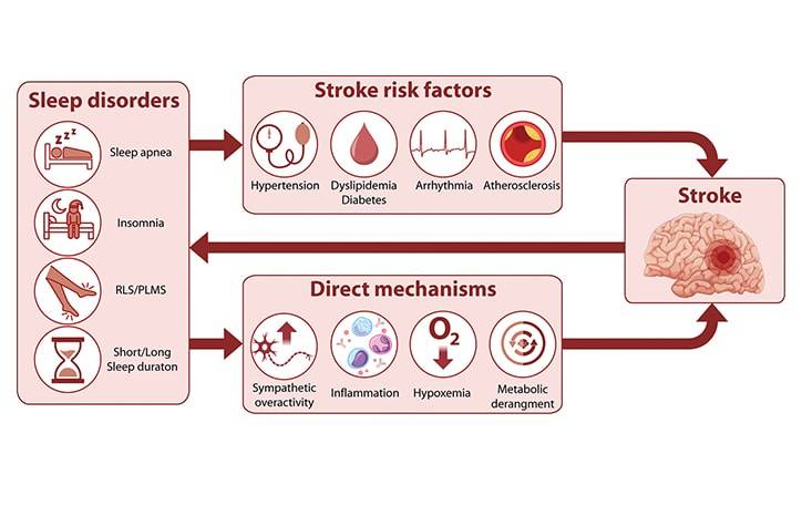 The Bidirectional Relationship Between Sleep Disorders and Stroke
