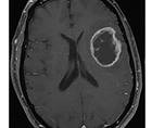 Challenge Case Report Subacute Cognitive Decline