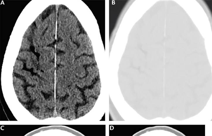 Stroke Snapshot Stroke Due to Hemodialysis Associated Air Embolism