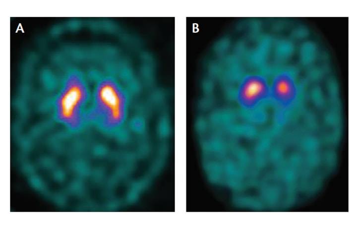 Imaging in Parkinsons Disease