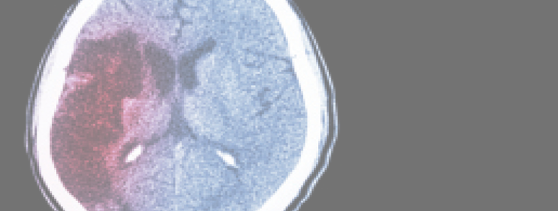 The Evolving Role of Neurologists in PFO Closure