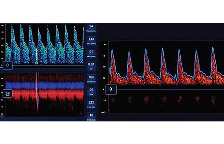 Neurologic Assessment and Neuromonitoring in the COVID 19 Pandemic
