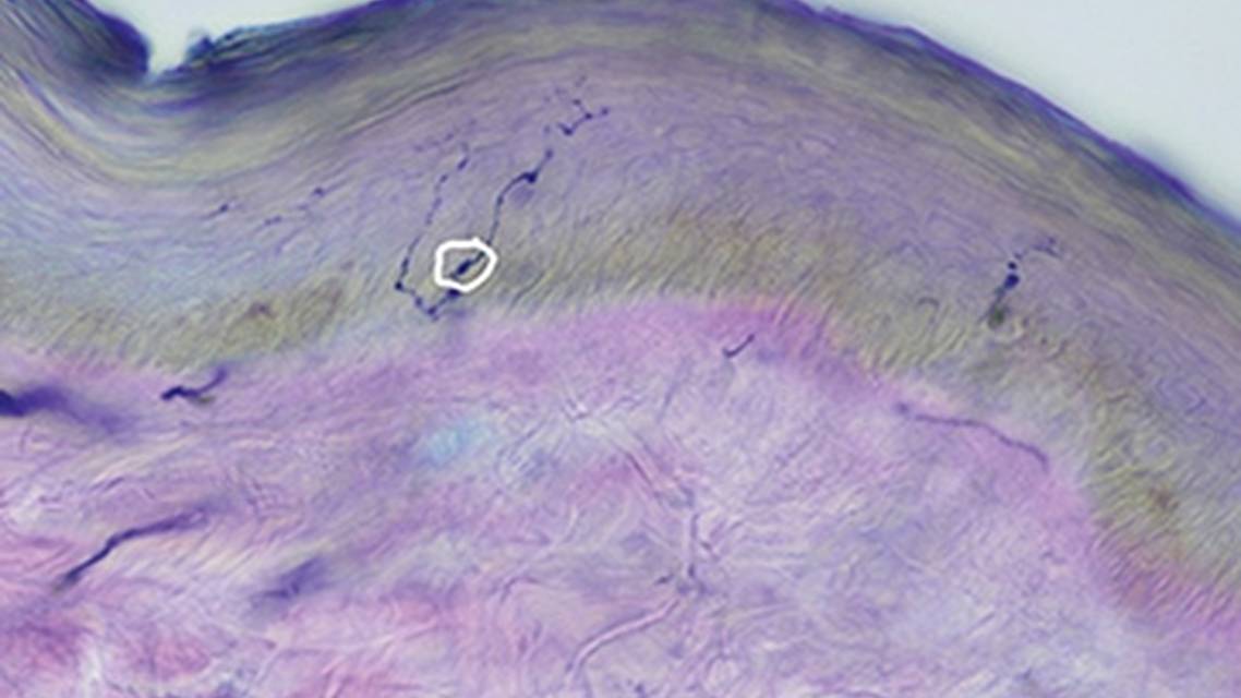 Utility of Skin Biopsy in Neuromuscular Disease