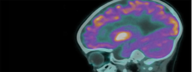 The RNA Blood Test for Multiple Sclerosis A New Tool for Early Disease Identification
