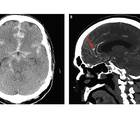 Case Report Cerebral Aneurysm Rerupture