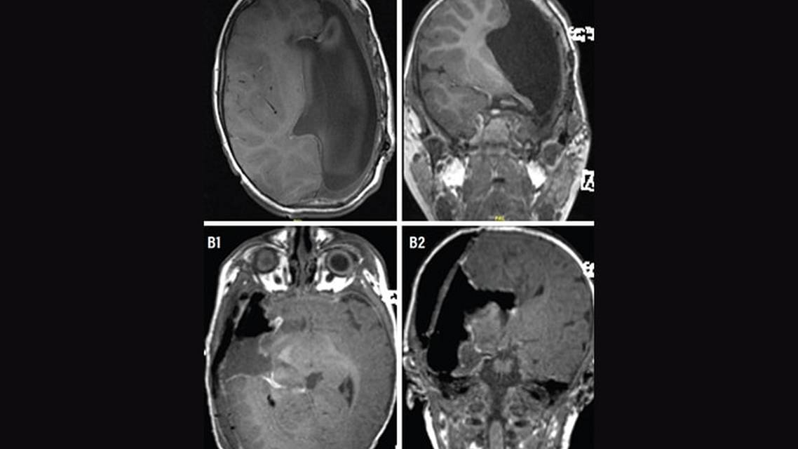 Epilepsy Essentials Hemispherectomy for Early Onset Pediatric Epilepsy A Big Surgery for Small People
