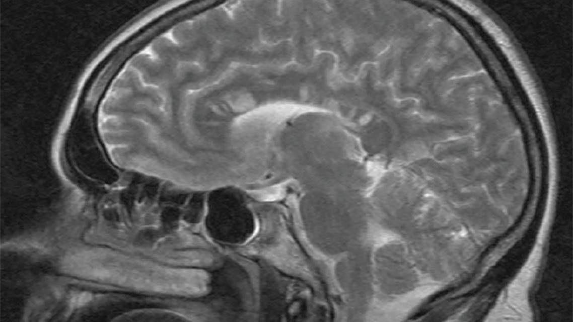 Susac Syndrome